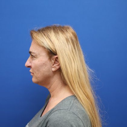 Facelift Before & After Patient #3035